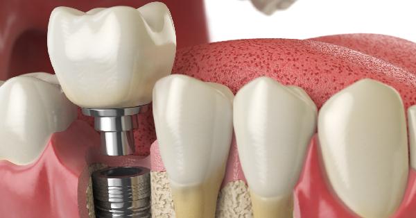 5 Common Myths About Dental Implants in Washington 5 Common Myths About Dental Implants in Washington
