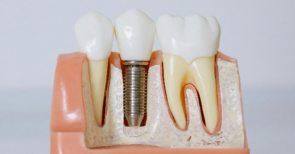 5 Key Signs You Need Dental Implants in Washington 5 Key Signs You Need Dental Implants in Washington