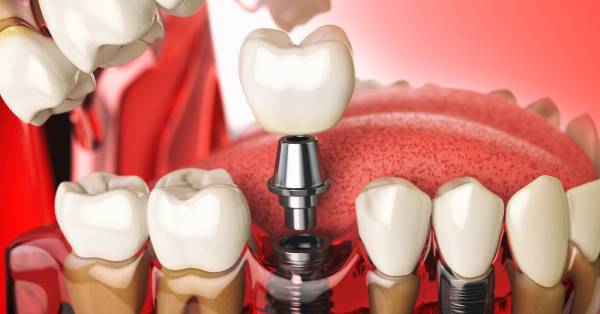 5 Nutrition Tips Post-Dental Implants in Washington 5 Nutrition Tips Post-Dental Implants in Washington
