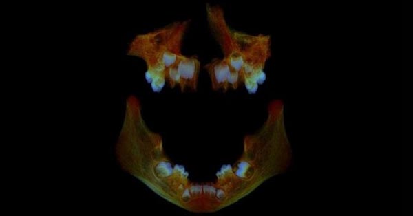 What Anglo Saxon teeth can tell us about modern health What Anglo Saxon teeth can tell us about modern health