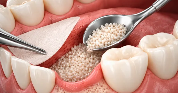 Bone Grafting in Washington showing a realistic dental procedure with bone graft material being placed into the jaw using surgical instruments in a clinical setting