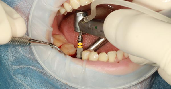 What Are the Common Side Effects of Dental Implant Surgery? What Are the Common Side Effects of Dental Implant Surgery?