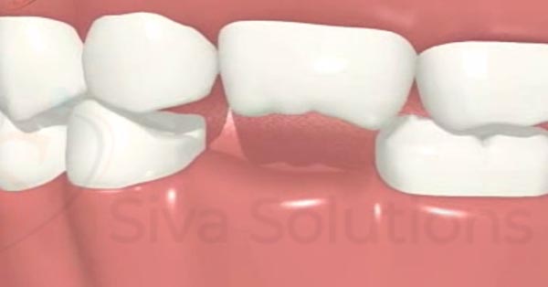 Dental Implant 101 Dental Implant 101