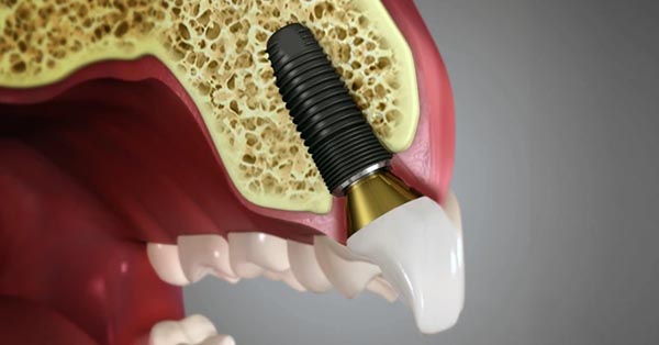 Dental Implant Process Take Time Dental Implant Process Take Time