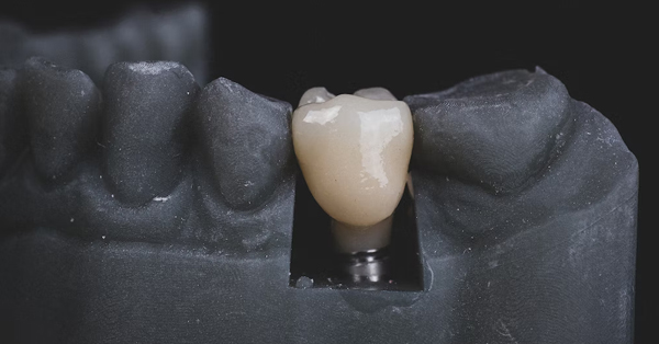 Dental Implants: A Great Alternative to Dentures and Bridges Dental Implants: A Great Alternative to Dentures and Bridges