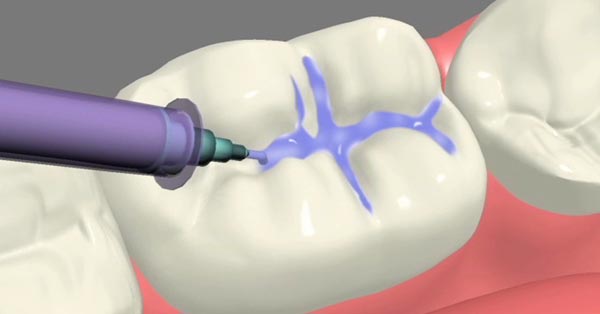 Dental Sealants Decrease Risk of Tooth Decay Dental Sealants Decrease Risk of Tooth Decay