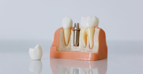 Discover 4 Different Types of Dental Implants in Washington Discover 4 Different Types of Dental Implants in Washington