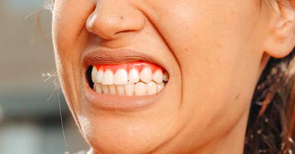 Gum Disease Gum Disease