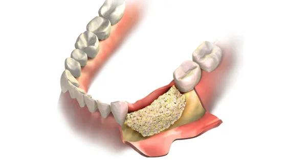 Healing and Recovery Stages of Bone Grafting in Washington Healing and Recovery Stages of Bone Grafting in Washington