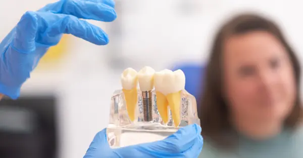 Healing Timeline for Dental Implants in Washington
