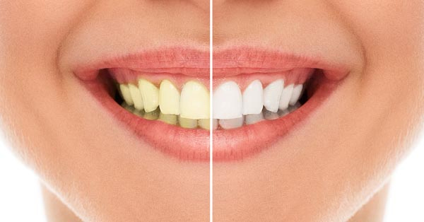 How to Get Whiter Teeth: Four Top Tips to Help Achieve a Brighter Smile