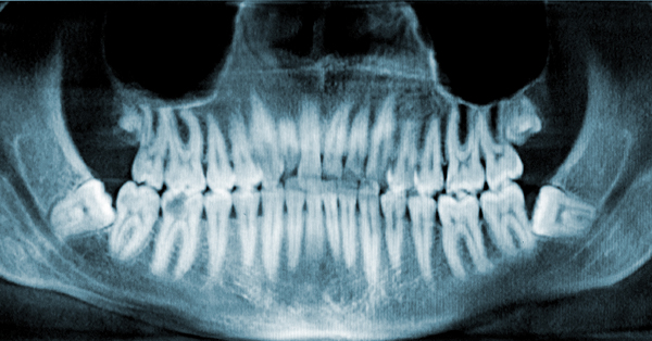Impacted Teeth: What You Need to Know for Successful Removal and Recovery Impacted Teeth: What You Need to Know for Successful Removal and Recovery
