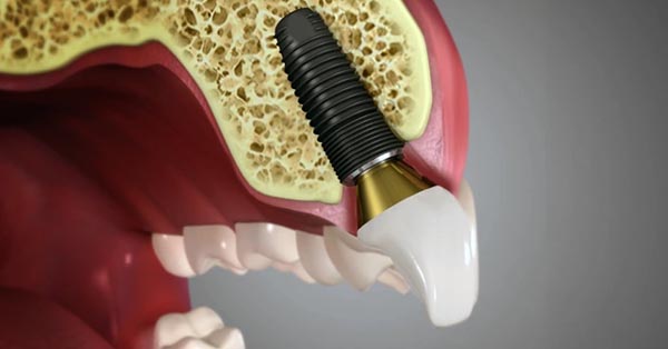 New Implant Advancement Hopes to Lower Risk of Infection New Implant Advancement Hopes to Lower Risk of Infection