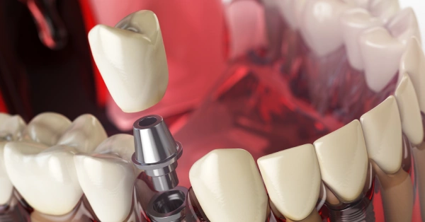 Recovery Do’s and Don’ts After Dental Implants in Washington