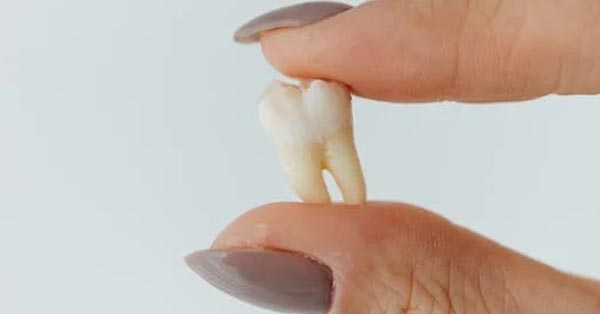 After the Removal of Multiple Teeth After the Removal of Multiple Teeth