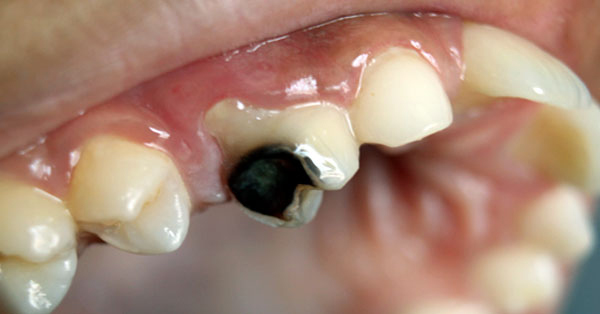 Sealants: Stop Cavities Before They Begin