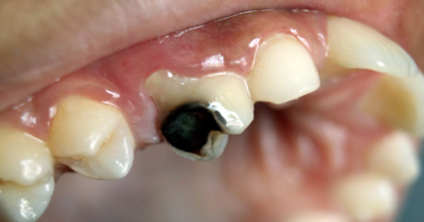 Sealants: Stop Cavities Before They Begin Sealants: Stop Cavities Before They Begin