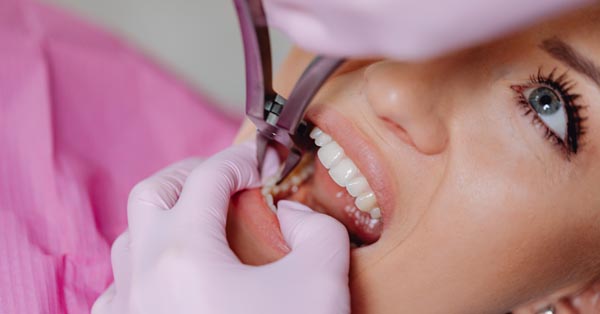 Should You Have Your Wisdom Teeth Removed? Should You Have Your Wisdom Teeth Removed?