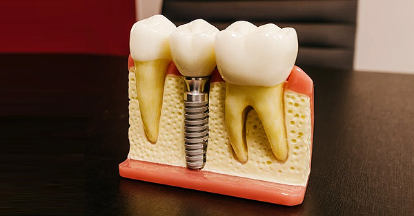 Six Questions to Ask Your Oral Surgeon Before a Procedure Six Questions to Ask Your Oral Surgeon Before a Procedure