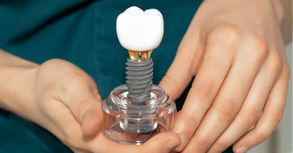 Step-by-Step Process of Dental Implants in Washington Step-by-Step Process of Dental Implants in Washington