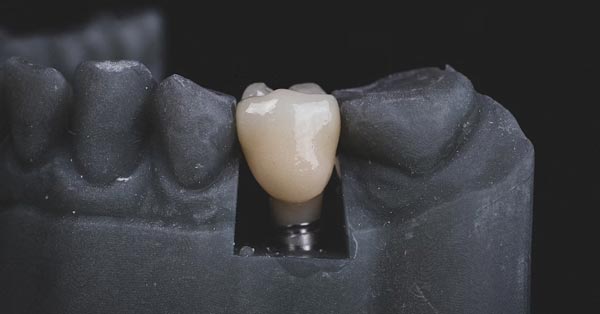  The Role of Bone Grafting for Dental Implants