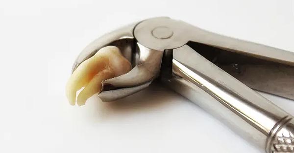 The Wise Patient’s Cheat Sheet on Wisdom Teeth Removal The Wise Patient’s Cheat Sheet on Wisdom Teeth Removal