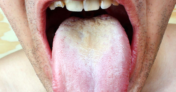 Thrush — the White Stuff Growing in Your Mouth (and How to Get Rid of it)