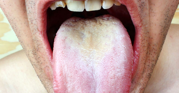Thrush — the White Stuff Growing in Your Mouth (and How to Get Rid of it) Thrush — the White Stuff Growing in Your Mouth (and How to Get Rid of it)