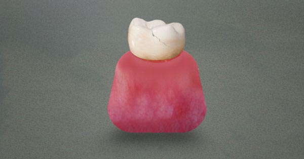 Traumatic Dental Injuries Traumatic Dental Injuries