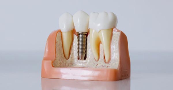 What Are Dental Implants?