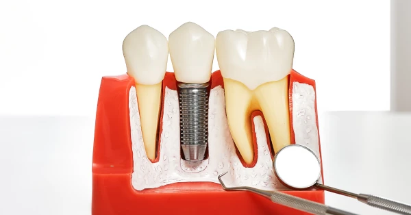 What to Know About Dental Implants in Washington