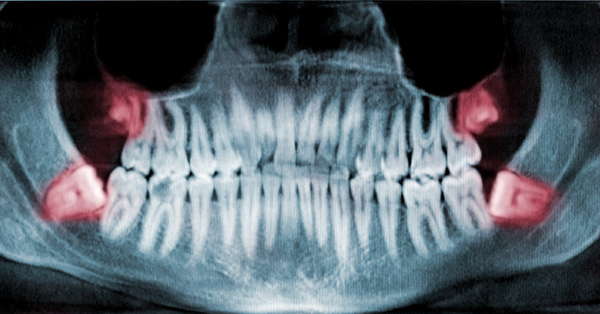 When Should I Have my Wisdom Teeth Removed? When Should I Have my Wisdom Teeth Removed?