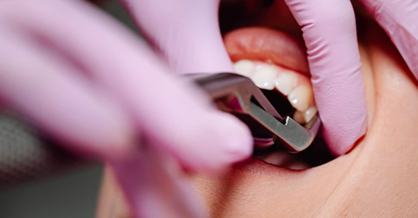 The Why’s and How’s of Adult Wisdom Tooth Extraction