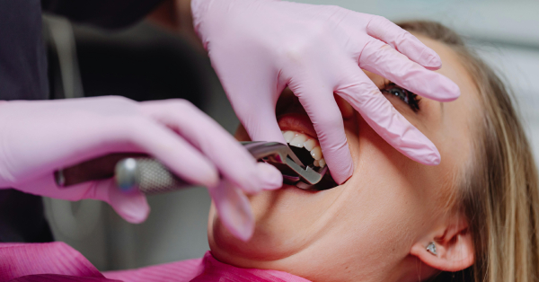 Wisdom Teeth Removal in Washington: Recovery Timeline Wisdom Teeth Removal in Washington: Recovery Timeline