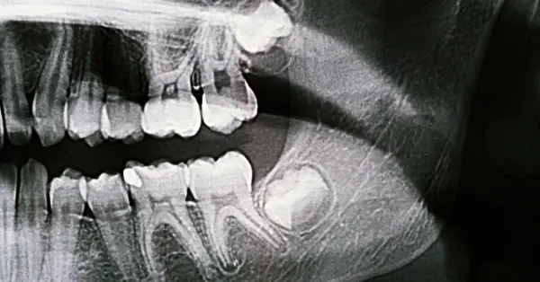 Helpful dental information about wisdom teeth removal in Washington DC