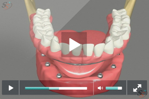 Fixed Implant Denture Option - Mandibular Fixed Implant Denture Option - Mandibular