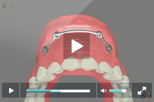 Fixed Implant Denture Option - Maxillary Fixed Implant Denture Option - Maxillary