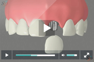 Immediate Implant Placement Immediate Implant Placement