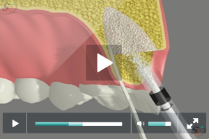 Implant Placement Following Bone Grafting Implant Placement Following Bone Grafting