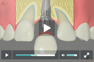 Implant Restoration - Option 2 Implant Restoration - Option 2