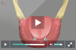 Implant Supported Denture - Scenario 1 Implant Supported Denture - Scenario 1