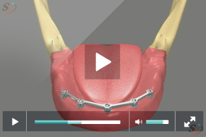 Implant Supported Denture - Scenario 3 Implant Supported Denture - Scenario 3