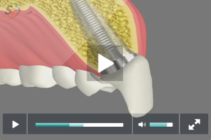 Why Implants Why Implants