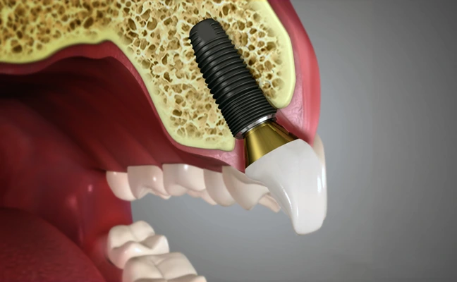 Dental Implants
